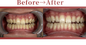 成人矯正の症例beforeafter写真