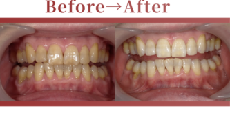 成人矯正の症例beforeafter写真