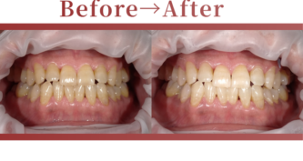 成人矯正の症例beforeafter写真