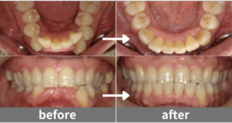 成人矯正の症例beforeafter写真