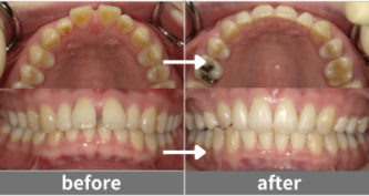成人矯正の症例beforeafter写真